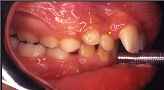 dentes a mais
