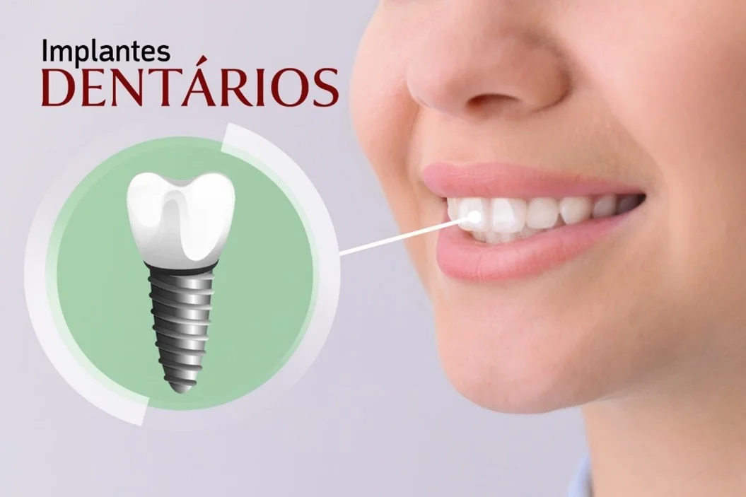 Vantagens dos tratamentos com implantes
