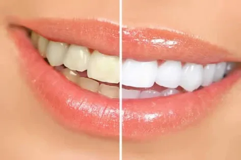 branqueamento dentário