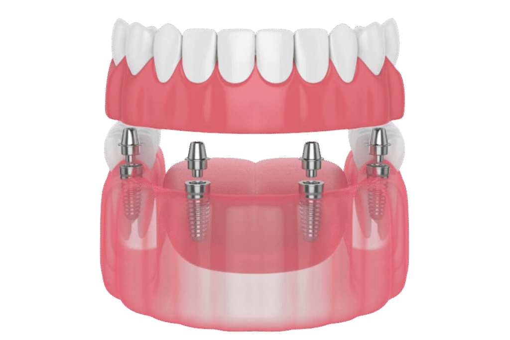 implantes dentários