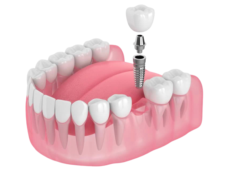 implantes dentários